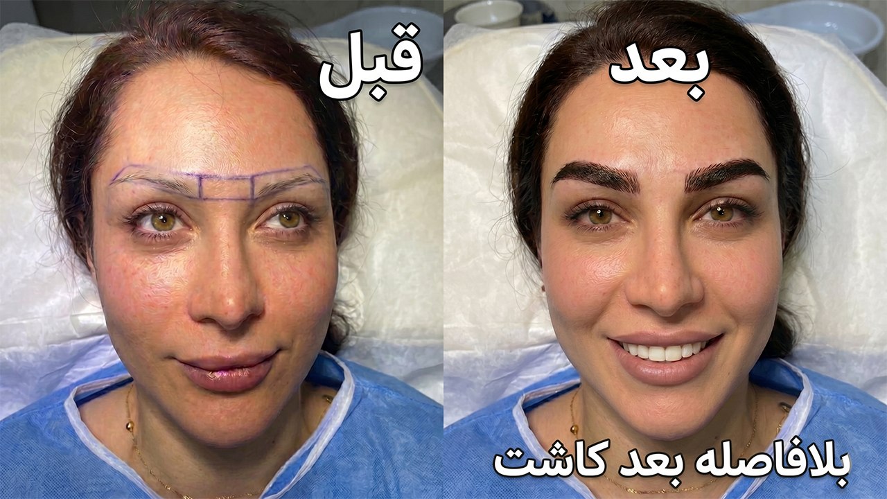 کاشت مو👈نمونه ها نچرال ببین