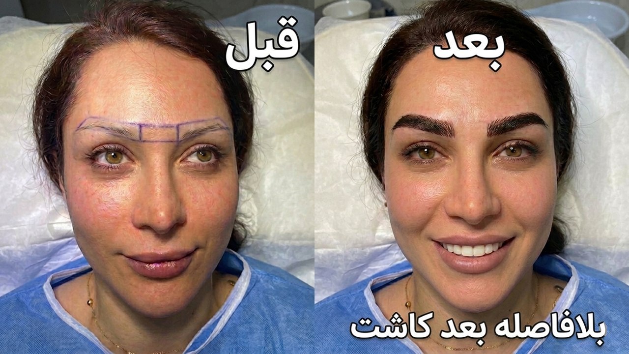 کاشت مو👈نمونه ها نچرال ببین
